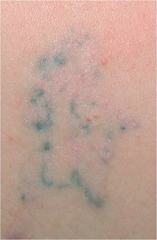 Tattoo After One Treatment